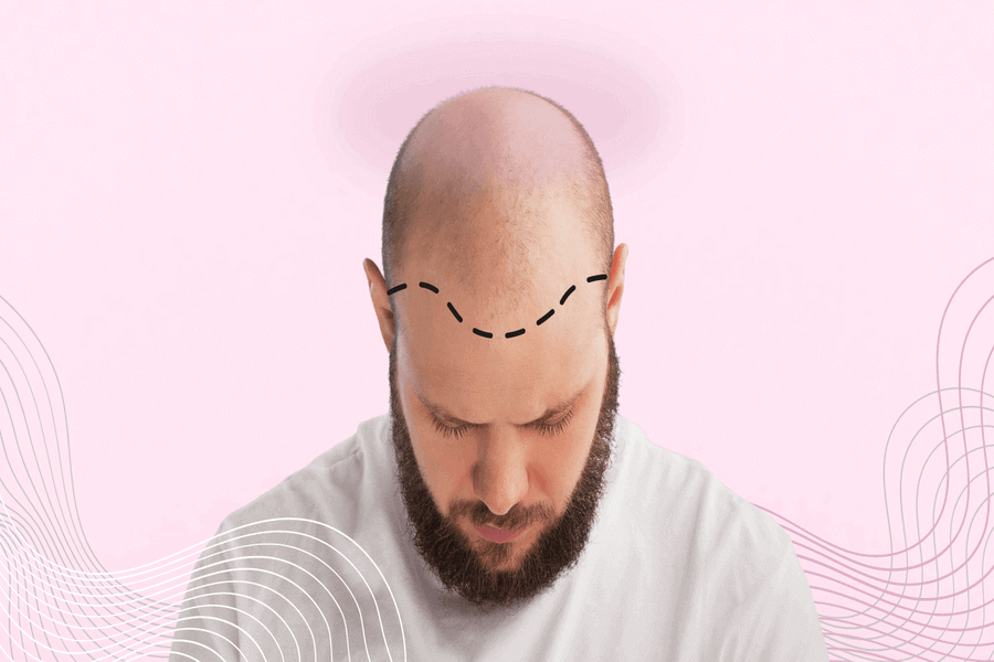 ՏՐԱՆՍՊԼԱՆՏԱՑԻԱ - մազերի փոխպատվաստում