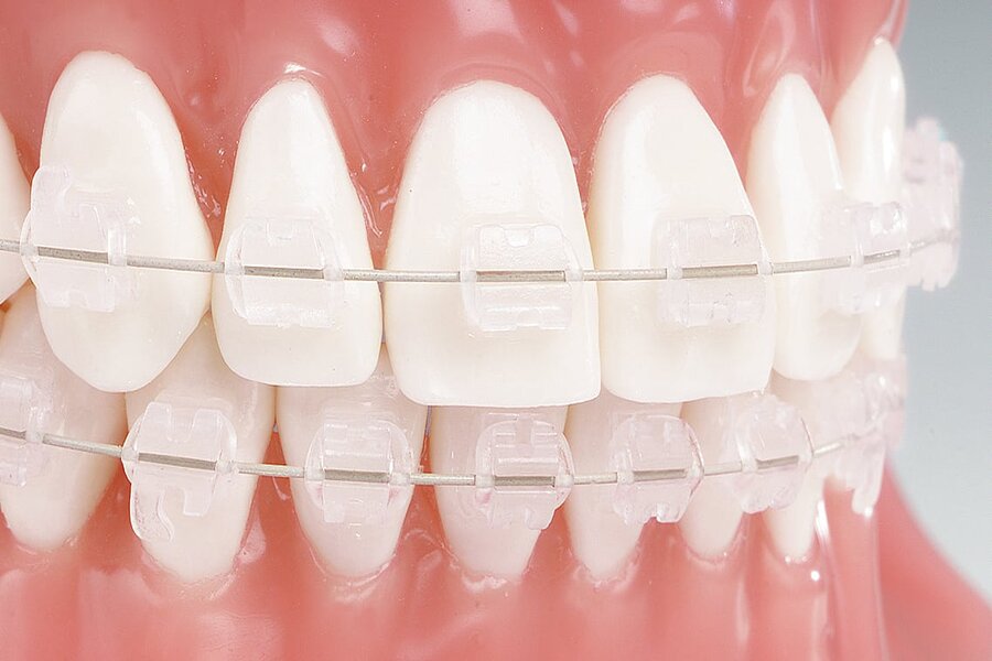 ԿԵՐԱՄԻԿԱԿԱՆ ԲՐԵԿԵՏՆԵՐ / ԿԵՐԱՄԻԿԱԿԱՆ ԲՐԵԿԵՏՆԵՐԻ ԱՌԱՎԵԼՈՒԹՅՈՒՆԵՐԸ ԵՎ ԹԵՐՈՒԹՅՈՒՆԵՐԸ - KERAMIKAKAN BREKETNER - BREKET