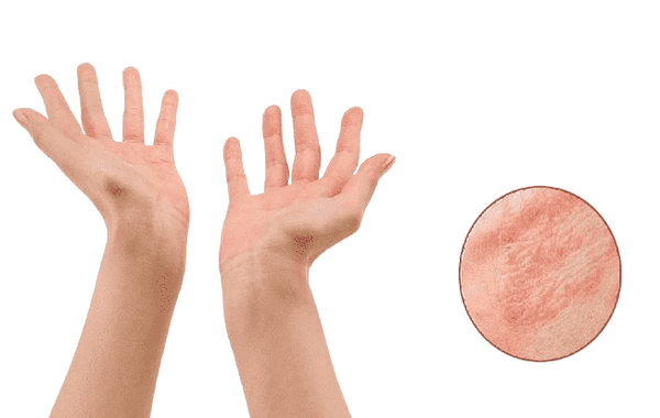 ԷԿԶԵՄԱ / ԷԿԶԵՄԱՅԻ ՊԱՏՃԱՌՆԵՐԸ, ՍԻՄՊՏՈՄՆԵՐԸ ԵՎ ԲՈՒԺՈՒՄԸ