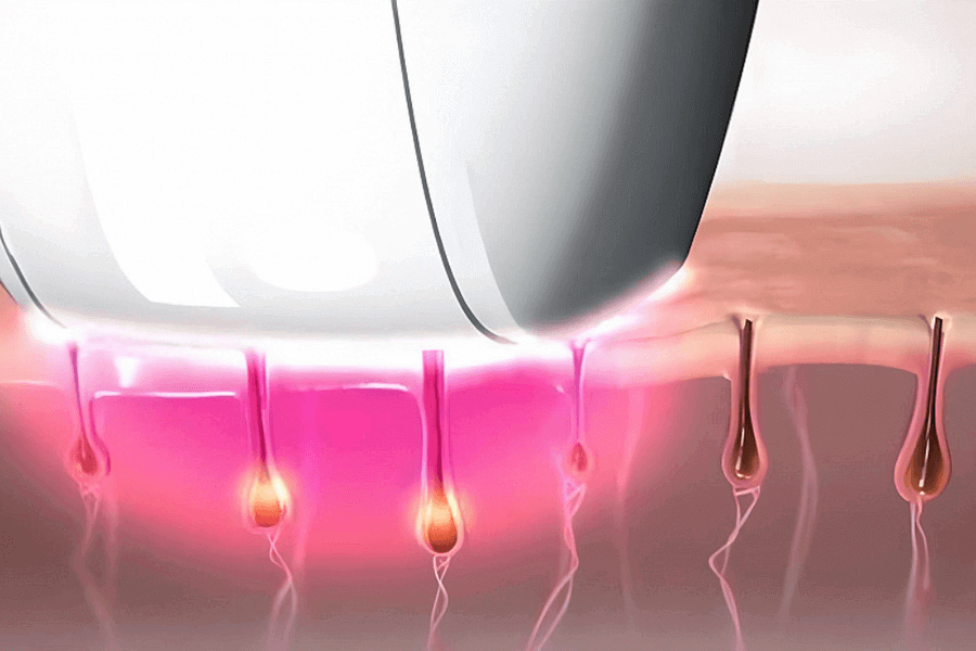 ԴԻՈԴԱՅԻՆ ԼԱԶԵՐԱՅԻՆ ՄԱԶԱՀԵՌԱՑՈՒՄ - ԷՊԻԼՅԱՑԻԱ - էսթետիկ բժշկության կենտրոն - էսթետկ բժշկություն - կոսմետոլոգիա - դիոդային լազերային մազահեռացում