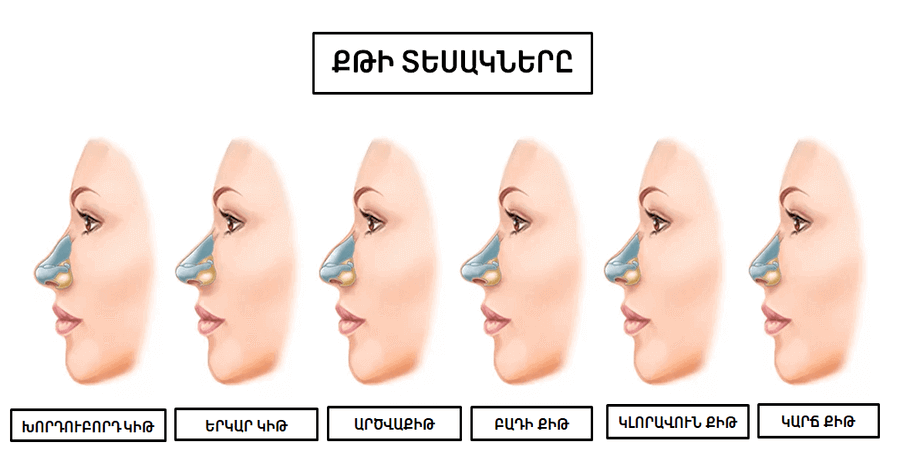 ՔԹԻ-ՊԼԱՍՏԻԿ-ՎԻՐԱՀԱՏՈՒԹՅՈՒՆ-ՔԹԻ-ՏԵՍԱԿՆԵՐԸ-ՌԻՆՈՊԼԱՍՏԻԿԱ - ՊԼԱՍՏԻԿ ՎԻՐԱԲՈՒԺՈՒԹՅՈՒՆ - ՊԼԱՍՏԻԿԱ