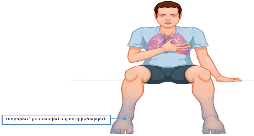 ՍՐՏԱՅԻՆ ԱՆԲԱՎԱՐԱՐՈՒԹՅՈՒՆ - SIRT