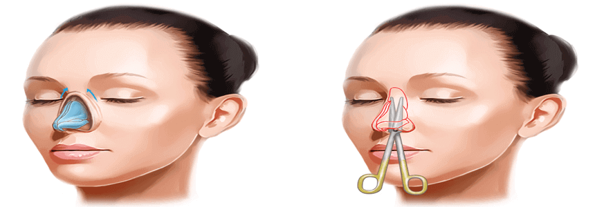 ՌԻՆՈՊԼԱՍՏԻԿԱ ( ՔԹԻ ՊԼԱՍՏԻԿ ՎԻՐԱՀԱՏՈՒԹՅՈՒՆ ՎԻՐԱԲՈՒԺՈՒԹՅՈՒՆ ) ՌԻՆՈՊԼԱՍՏԻԿԱՅԻ ԿԵՆՏՐՈՆՆԵՐ RHINOPLASTY - RINOPLASTIKA - QTI VIRAHATUTYUN