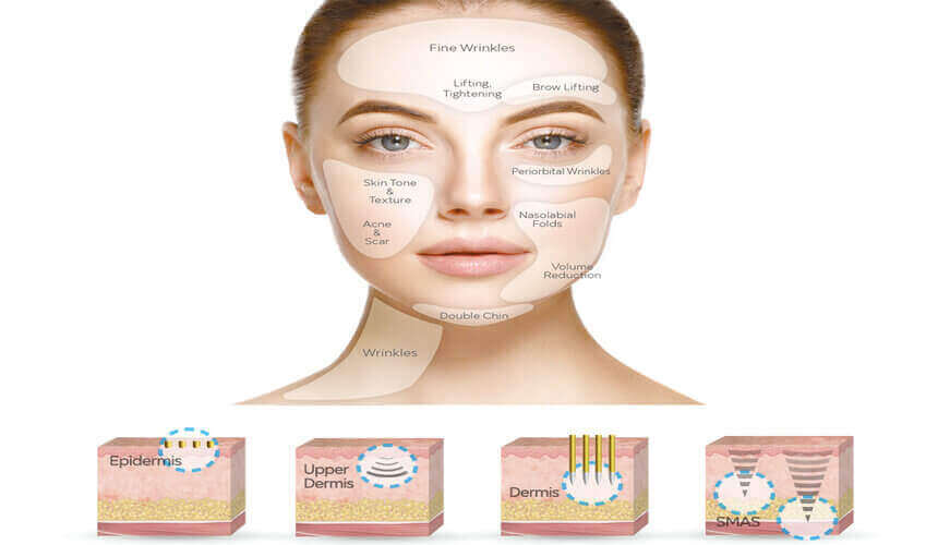 HIFU SMAS ԼԻՖՏԻՆԳ  Ի՞ՆՉ Է HIFU ՏԵԽՆՈԼՈԳԻԱՆ - SMAS LIFTING - HI FU ԼԻՖԹԻՆԳ - ԼԻՖՏԻՆԳ  - ԵՐԻՏԱՍԱՐԴԱՑՈՒՄ