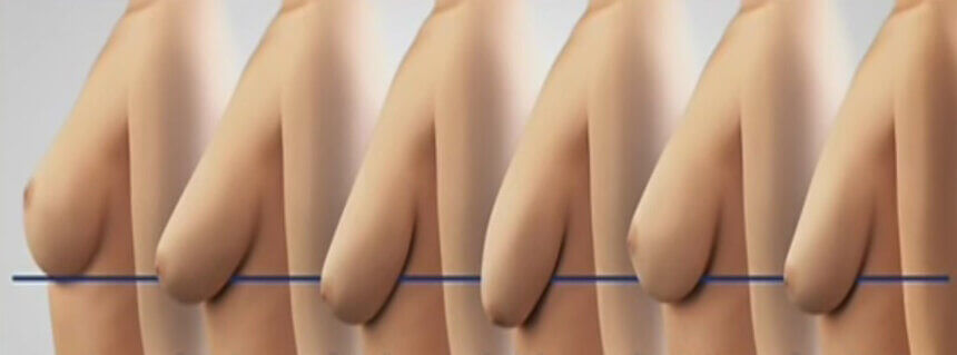 ՄԱՔՍՏՈՊԵՔՍԻԱ  ԿՐԾՔԻ ՁԳՈՒՄ ( ԼԻՖՏԻՆԳ )  ՊԼԱՍՏԻԿ ՎԻՐԱԲՈՒԺՈՒԹՅՈՒՆ - ՊԼԱՍՏԻԿ ՎԻՐԱԲՈՒԺՈՒԹՅԱՆ ԿԵՆՏՐՈՆ - ԿԵՆՏՐՈՆՆԵՐ