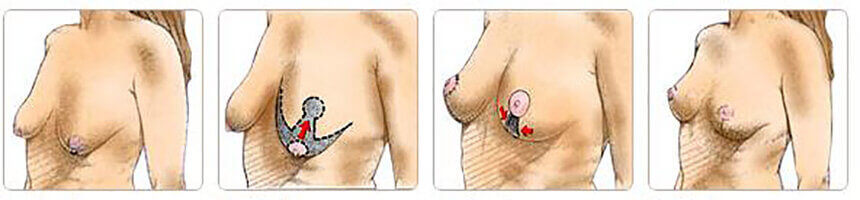 ՊԼԱՍՏԻԿ ՎԻՐԱՀԱՏՈՒԹՅՈՒՆ - ԿՈՒՐԾՔ - ԿՐԾՔԵՐ 