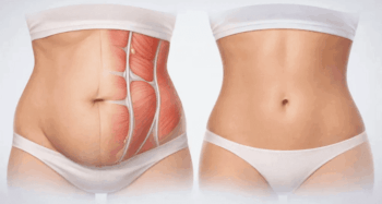 ԱԲԴՈՄԻՆՈՊԼԱՍՏԻԿԱ